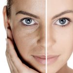 platelet rich plasma