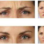 botox