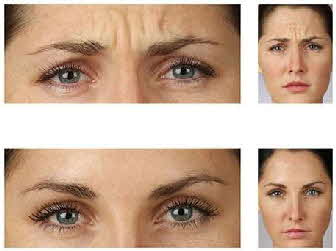 Botox